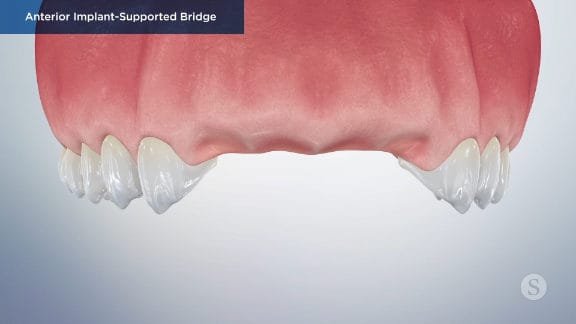 Missing anterior teeth in upper arch