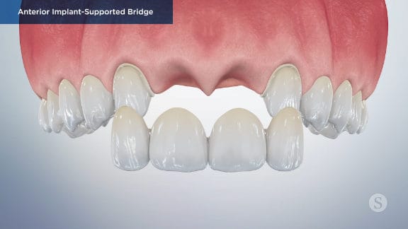 Final bridge placed and adjusted