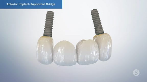 Implants supporting multiple teeth