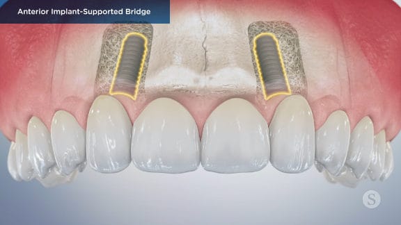 Implants mimicking tooth roots