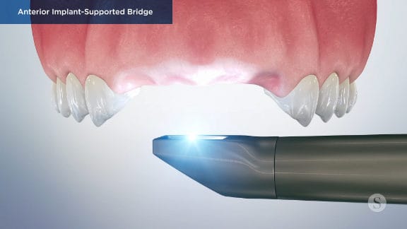 Intraoral scanner capturing 3D images