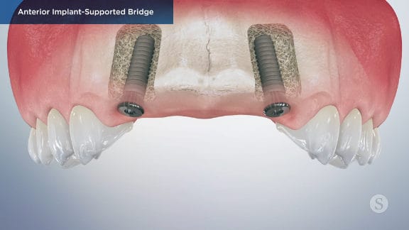 Implants placed with healing caps