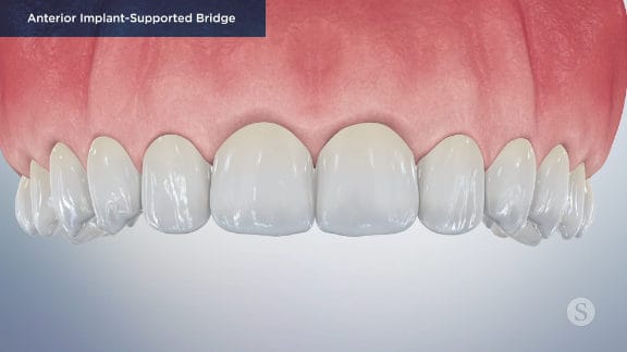 Temporary restoration during healing