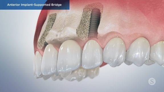 Monitoring implant healing process