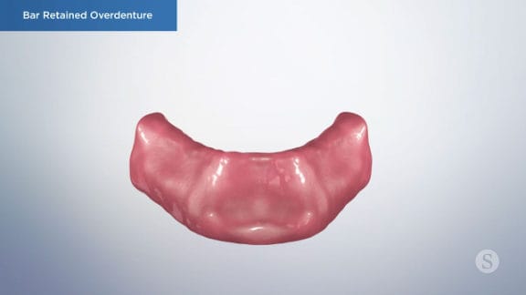 Illustration of lower arch for overdenture