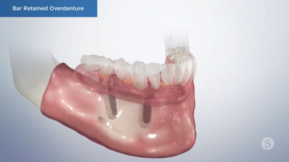 Overdenture supported by implants
