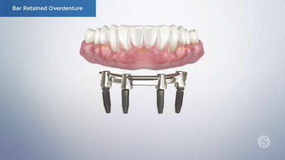 Bar retained overdenture with clips and implants