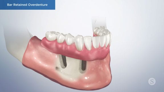 Implants supporting overdenture for stability