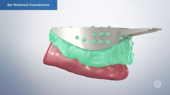 Impression process for overdenture planning