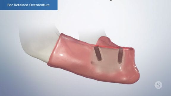 Implants placed with healing caps