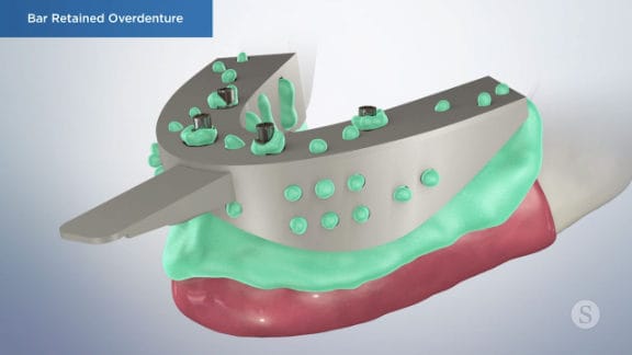 Impressions taken for final overdenture and bar