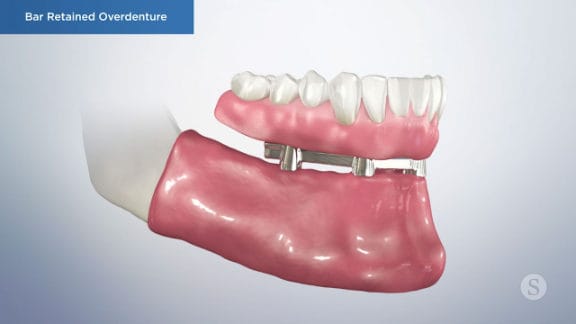 Final overdenture fitted onto bar