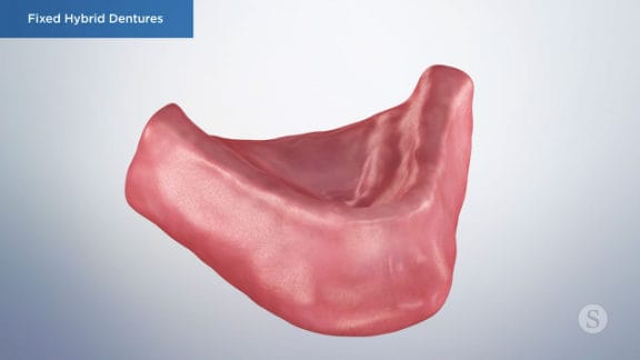 Illustration of the lower arch for fixed hybrid dentures