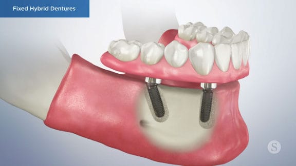 Illustration of a screw-retained denture supported by implants