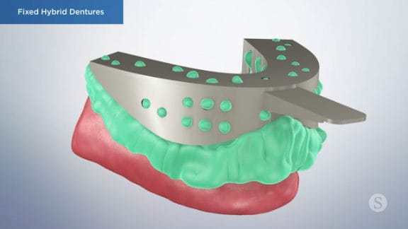 Illustration of an impression guide for temporary fixed hybrid dentures