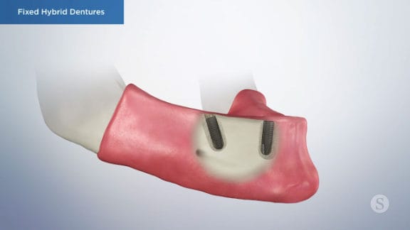 Illustration of placed dental implants in the arch