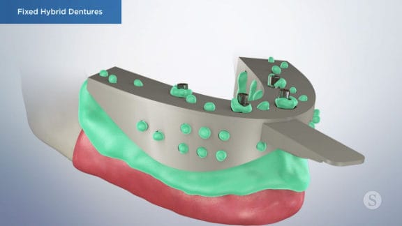 Illustration of impressions being taken for the final fixed hybrid dentures