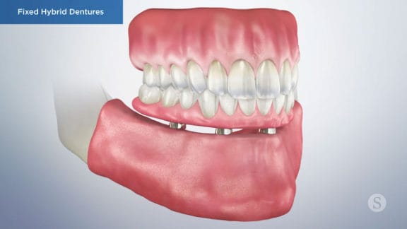Illustration of the completed fixed hybrid denture process