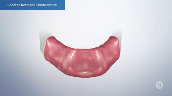 Lower arch for locator overdenture