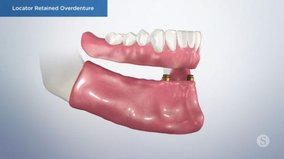 Completed locator overdenture restoration
