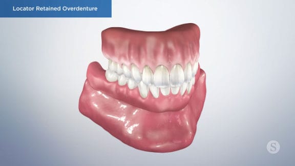 Overdenture replacing missing teeth