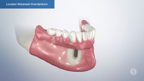 Removable overdenture prosthesis