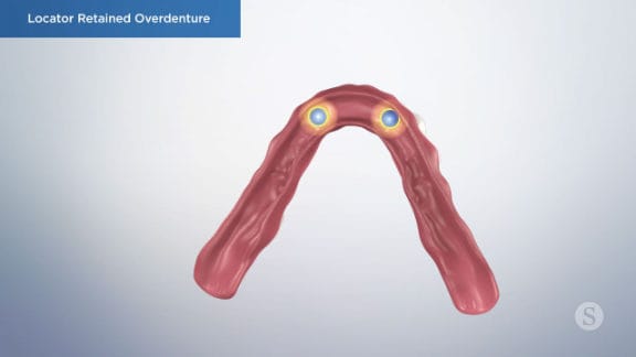 Implants preserving jawbone structure