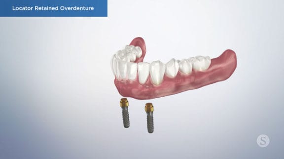 Temporary denture and implant planning
