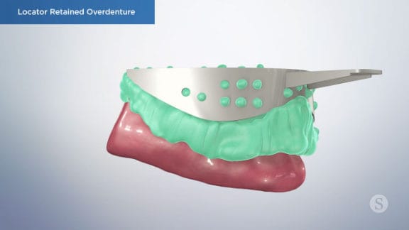 Implants placed with healing caps