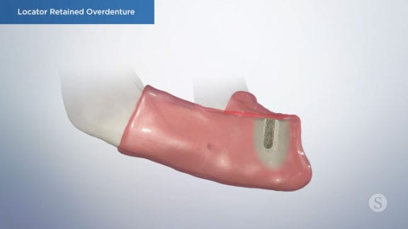 Final overdenture impressions and fabrication