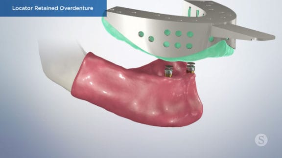 Final overdenture placement onto locators